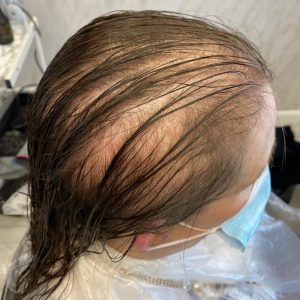 Lady with brown hair and severe hair loss